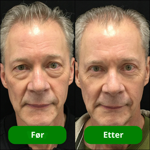 Cëlyn™ - Øyeoppstrammende krem med anti-aldringseffekt