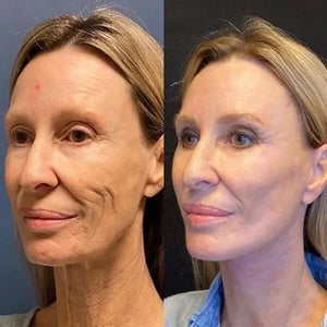 Botox Ansiktsserum by Rask Oslo